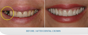 dental-crown-before-after